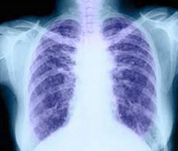 cancer-pulmon-radiografia